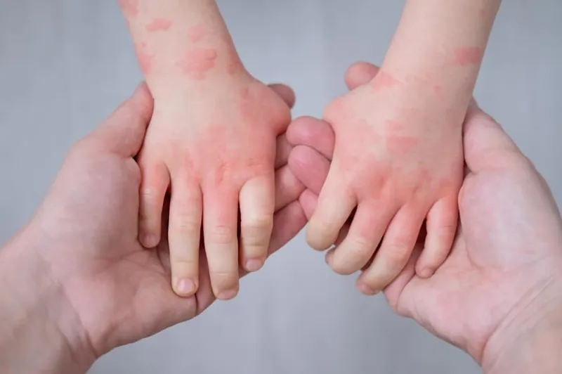 Dermatitis atópica: La primera en la lista de alergias comunes