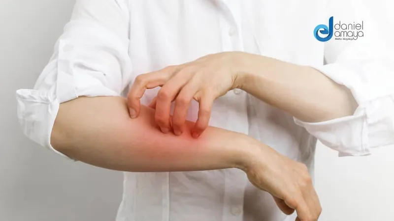 Alergias en la Piel : Tratando las reacciones cutáneas