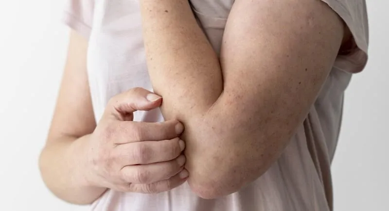 Dermatitis por estrés: tratamiento y prevención