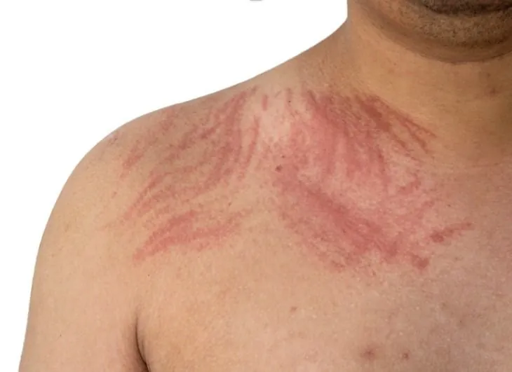¿Sufres Dermografismo? Conoce cómo identificarlo y tratarlo