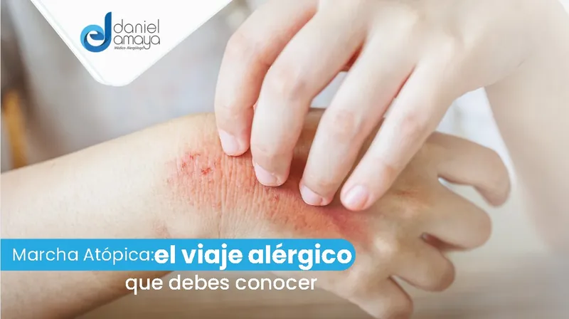 Marcha atópica: el viaje alérgico que debes conocer