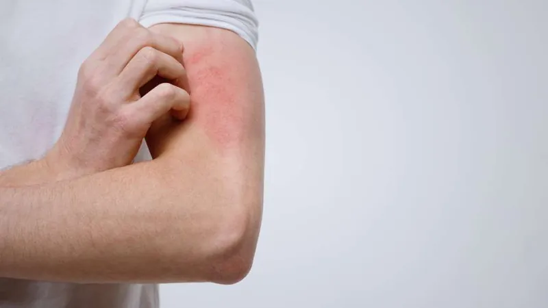 Dermatitis Atópica : Un experto responde a tus preguntas