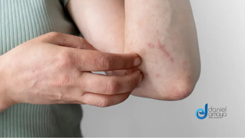 Reacción alérgica: la respuesta sobreactuada del cuerpo a algunas sustancias