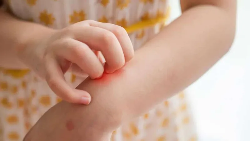 Niños con Dermatitis Atopica