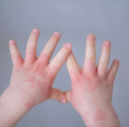 Dermatitis Atópica en bebés y niños Dr. Daniel Amaya Dermatitis Atópica en bebés y niños Dr. Daniel Amaya