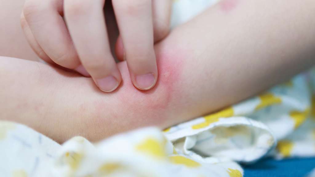 Alergias dermatológicas en los niños, Dr. Daniel Amaya Ruiz, Médico Alergólogo Alergias dermatológicas en los niños, Dr. Daniel Amaya Ruiz, Médico Alergólogo